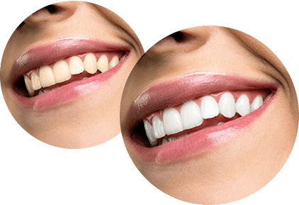 Uitstekend goud Manier Prachtige witte tanden - Witte Tanden Oisterwijk